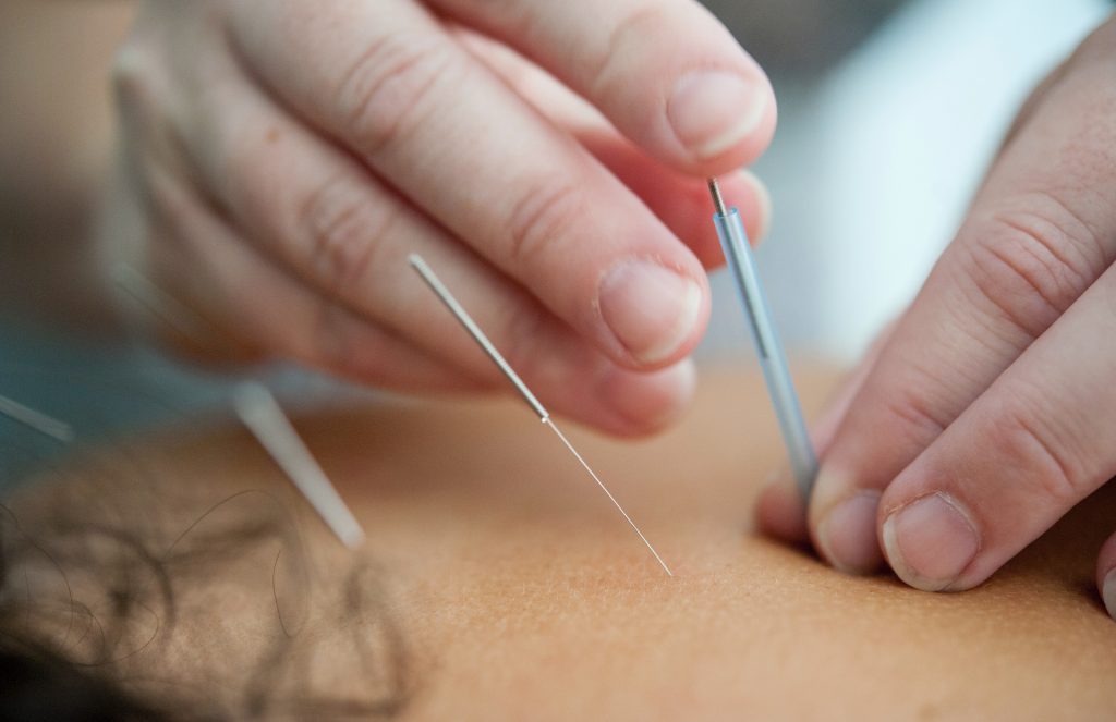 Acupuncture for cancer-related brain fog